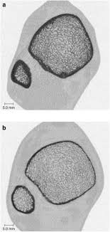 Osteoporosis And Chronic Kidney Disease Mineral And Bone Disorder Ckd Mbd Back To Basics American Journal Of Kidney Diseases