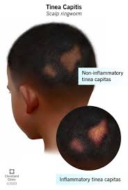 Image result for sores on the head in children