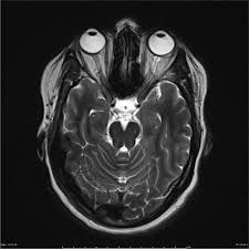 Optic Neuritis Radiology Reference Article Radiopaedia Org