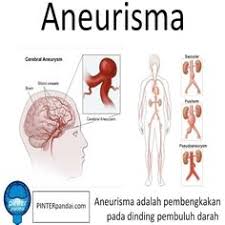 Plak adalah zat keras yang merusak arteri dan mencegah darah mengalir dengan bebas. 190 Ide Penyakit Disease Di 2021 Penyakit Radioterapi Sindrom Ovarium Polikistik