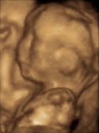 3d Ultrasound Wikipedia