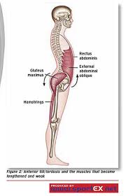 Anterior Tilt Lordosis And The Muscles That Become Lengthened And Weak Pelvic Tilt Lumbar Lordosis Human Body Anatomy