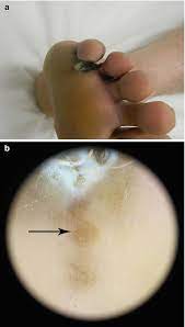Melanoma can also occur in your toenails. An Acral Lentiginous Melanoma Presented As Interdigital Erosion In A 38 Year Old Patient Springerlink