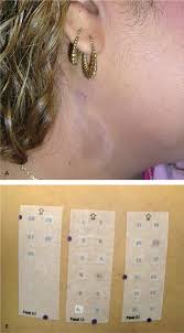 Diagnosis And Management Of Contact Dermatitis American Family Physician