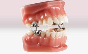 Below, you'll learn more about the different types of orthodontic treatments available so you can choose what's best for you. Aoa Access Product List
