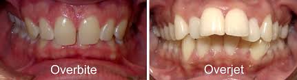 Check spelling or type a new query. What Is Overbite Symptoms Diagnosis And Treatment