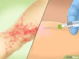 How To Treat Pinpoint Petechiae: 10 Steps (With Pictures)