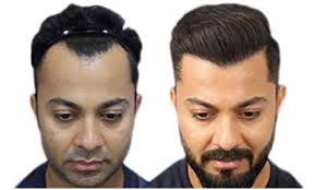 Best Hair Transplant Surgeons based