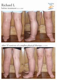We did not find results for: Manual Lymph Drainage Mld Nottingham For Lymphoedema