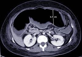 Image result for Megacolon