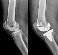The posterior condylar offset ratio and femoral anatomy in ...
