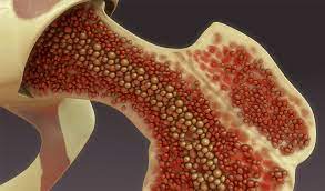 What is cancer of bone marrow. Cancer Fighting Immunotherapy Improved In Bone Marrow Ucl Cancer Institute Ucl University College London