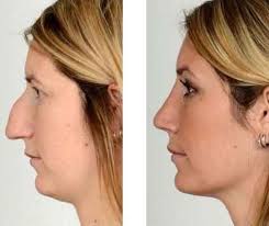 Plastic Surgery Associates 6 Rhinoplasty Plastic Surgery Rhinoplasty Surgery