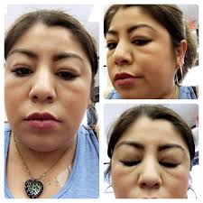 Is face swelling normal after dialysis?