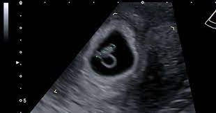 The most accurate time to date you pregnancy is after 8 weeks through to 13. 7 Week Baby Ultrasound Scan International Ultrasound Services