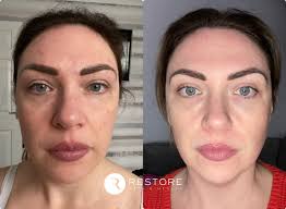 Restore Skin & Health