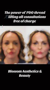 #pdoliftingthreads #threadfacelift #lookingfresh #tightening  #pdoliftingthreads #snatched #YouthfulLook #youthfulskin @highlight Blossom  Aesthetics & Beauty