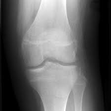 · last updated:march 8, 2021. Segond Fracture With Avulsion Of Acl Radiology Case Radiopaedia Org