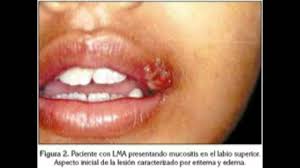 Factores de riesgo.¿qué es y cuáles son los principales síntomas?¿cómo se diagnostica un linfoma?¿cuáles son los factores de r. Enfermedad De Hodgkin O Cancer Linfatico Youtube
