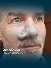 Facial Plastic Surgery: Restoring Confidence in Boston