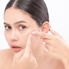 Dokter Kulit Jelaskan Mengapa Jerawat di Hidung Tidak Boleh  Dipencet-Lifestyle Arahkita.com