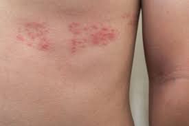 Health Well Being Mold Exposure Bells Palsy Shingling