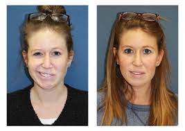 Jan 22, 2016 · the prognosis for individuals with bell's palsy is generally very good. Nyc Facial Nerve Paralysis Before And After Pictures Upper East Side