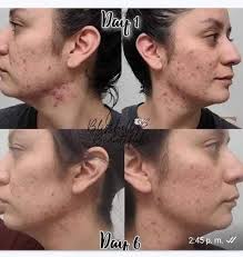 🌱La Linea Tea Tree de Farmasi ayuda a las PIELES GRASAS. Limpiadora 💲  2️⃣5️⃣0️⃣ Crema Facial 💲 3️⃣5️⃣0️⃣ BENEFICIOS DE LA LÍNEA DE TEA TREE ⤵️⤵️  🌿Elimina piel grasa 🌿Controla el acné.