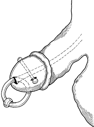 Illustration sketches the piercing jewellery placement of the patient. |  Download Scientific Diagram