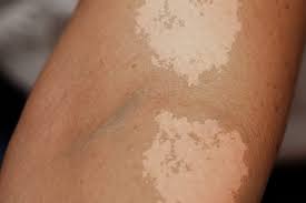 It results from a type of yeast that naturally lives on your skin. Tinea Versicolor Overview Causes Symptoms Treatment Illness Com