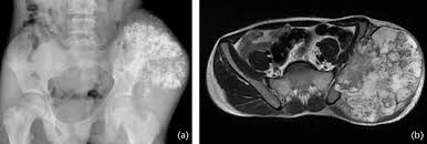 Image result for Chondrosarcoma