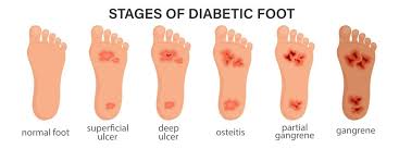 Image result for diabetic toes