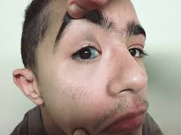 Image result for nevus sclerae