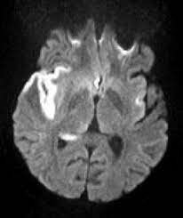 Misra uk, hashmi aa, kalita j. Herpes Simplex Encephalitis Radiology Reference Article Radiopaedia Org