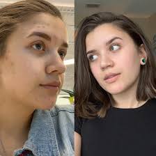$19.95 + $4.95 shipping and handling (every 30 days). One Year Of Using Curology I Used To Get Bad Hormonal Cystic Acne And This Has Helped Immensely Acne