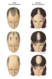 The drug is not formally approved for treating aga, but is commonly used off label for this indication. Patient Education Hair Loss In Men And Women Androgenetic Alopecia Beyond The Basics Uptodate