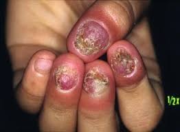 Image result for onychomycosis