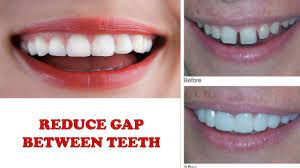 The idea behind this product is that you place a small band around the teeth you want to move each night. How To Reduce Gap Between Teeth Naturally Home Remedies Without Braces Teeth Braces Cost Space Between Teeth Teeth