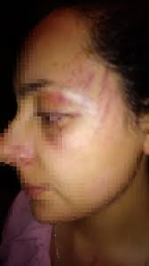 EL REGIDOR PRIISTA JESUS TENORIO POR CELOS GOLPEÓ Y MORDIÓ A SU SECRETARIA  Y NOVIA Reporteros en Movimiento