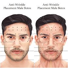 Male BOTOX Injection Points Bundle