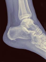 What Conditions Are Often Mistaken For Plantar Fasciitis Healing Plantar Fasciitis Plantar Fasciitis Exercises Plantar Fasciitis Symptoms