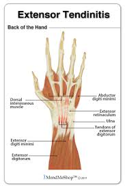 This mnt knowledge center article explains all about extensor tendons and what causes extensor tendonitis, including the symptoms and how is it. Extensor Wrist Tendinitis