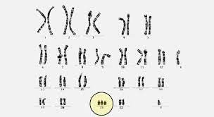 Chromosomendefekte Down Syndrom Trisomie 21