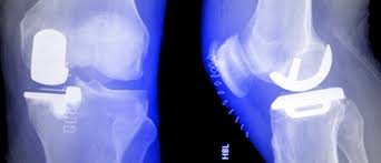 Depuis sa création, l'objectif n'a pas varié, défendre la prothèse face aux problèmes qui ne manquent de présenter. Prothese Unicompartimentale Du Genou Chirurgie Orthopedique Nice Dr Arnaud Clave