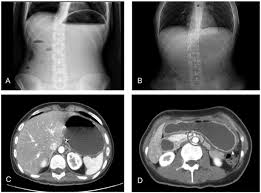 The fae twins (the dark fae series book 2) by g.k. Pediatric Wilkie S Syndrome Report Of Two Monozygotic Sisters Managed Conservatively Pediatrics Neonatology