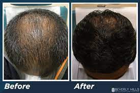 How much does laser hair therapy cost? Low Level Laser Therapy For Hair Loss Bhrc Medical Spa