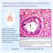 Educational Gif Pathology Of Respiratory Epithelial Adenomatoid Hamartoma Pathology Respiratory Chronic Sinusitis