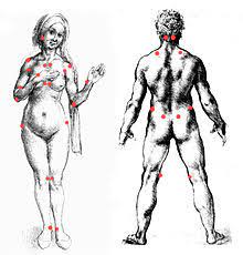 Symptoms include chronic muscle pain, fatigue, sleep problems, and painful. Fibromyalgie Wikipedia