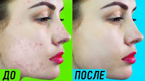как избавиться от прыщей в домашних условиях за 3 дня Kak Izbavitsya Ot Pryshej Za Odnu Noch Youtube