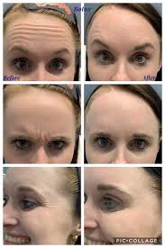Botox is a purified protein derived from the bacterium clostridium botulinum. Photo Gallery Medical Spa Des Moines Medspa